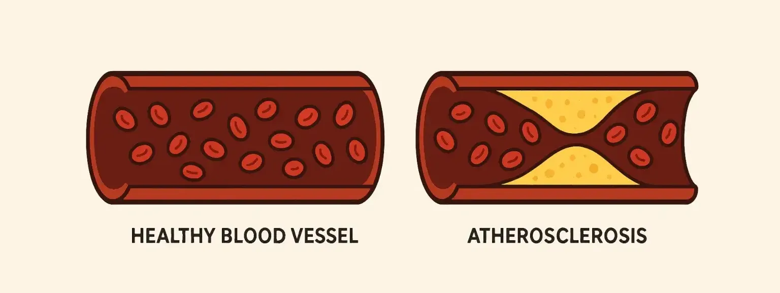 Healthy bloody vessels vs atherosclerosis